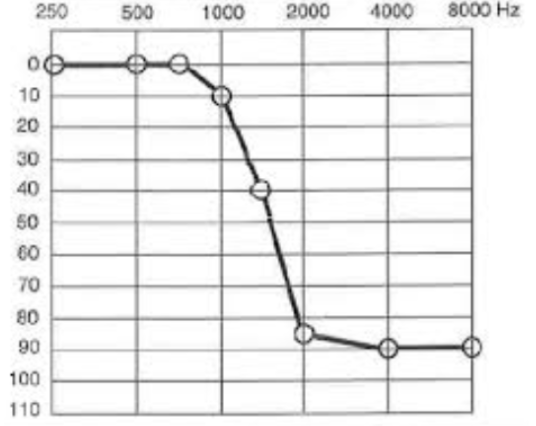 Graph Reverse Slope Hearing Loss